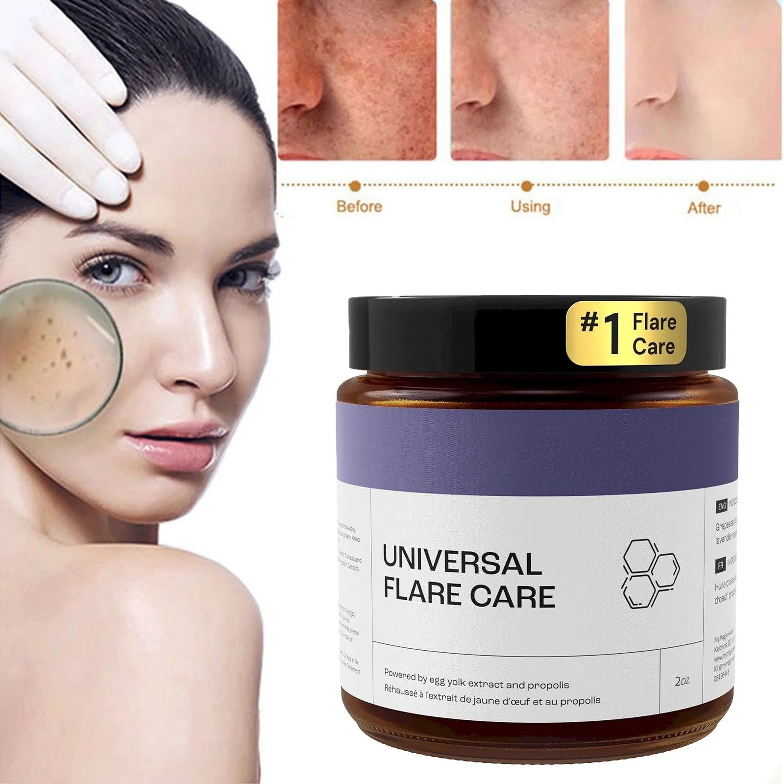 U Niversal | R Elieve Skin Problems | Hidradenitis Suppurativa Abscesses | Solution With And Egg Yolk Extracts 1.8 Oz